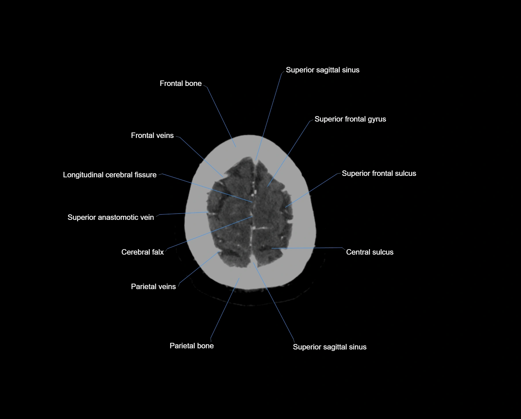 CT scan brain axial labelled cross sectional anatomy image-img-000066.webp